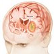 BestTumorEUW